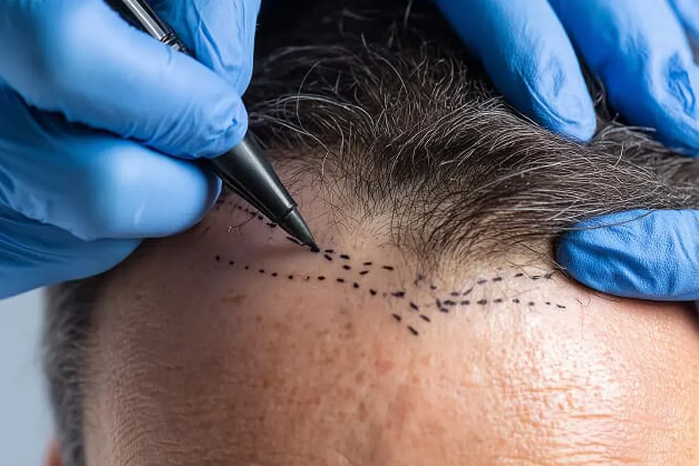 agencia-seo-clinicas-capilares